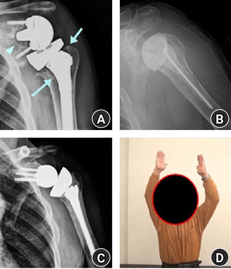 right total shoulder arthroplasty icd 10|right infected shoulder arthroplasty icd 10.